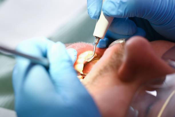 Best Knocked-Out Tooth (Avulsed Tooth) Treatment in Webster Groves, MO